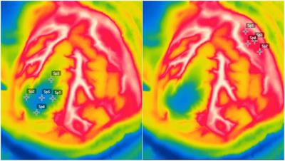 A prospective study on the usefulness of high-resolution intraoperative infrared thermography in intracranial tumors